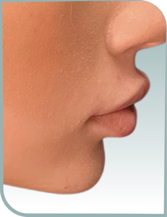 Chin and lip balance, Before photo (result 4 of 10)
