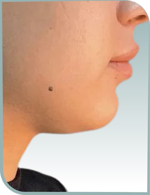 Jaw and neck contour, Before photo (result 5 of 10)