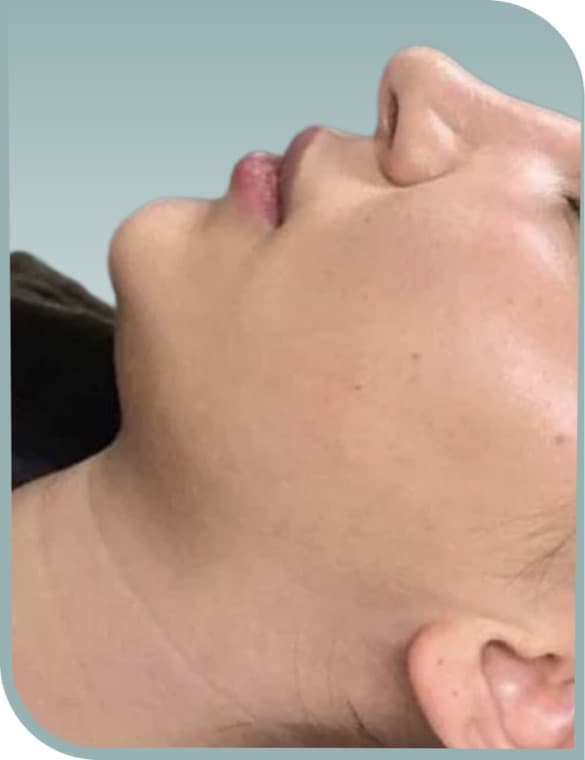 Submental contour, Before photo (result 6 of 10)