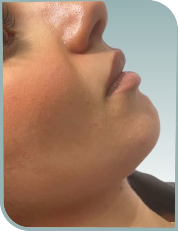 Jawline definition, Before photo (result 7 of 10)