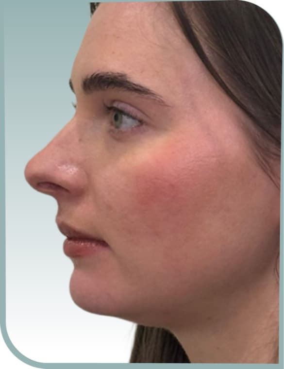 Jaw and chin shaping, Before photo (result 9 of 10)