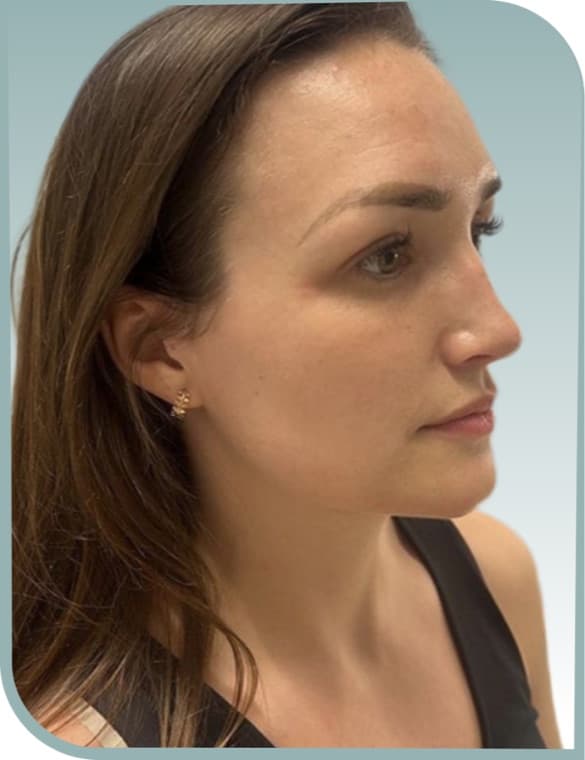 Jawline shaping, Before photo (result 10 of 10)