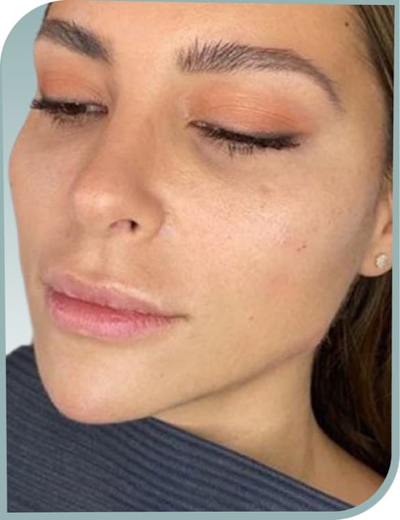 Lower face contour, After photo (result 3 of 10)