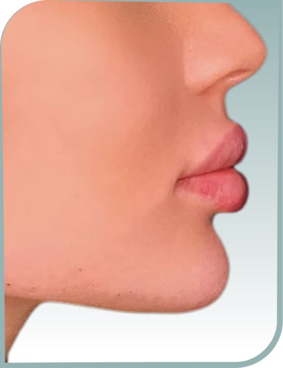 Chin and lip balance, After photo