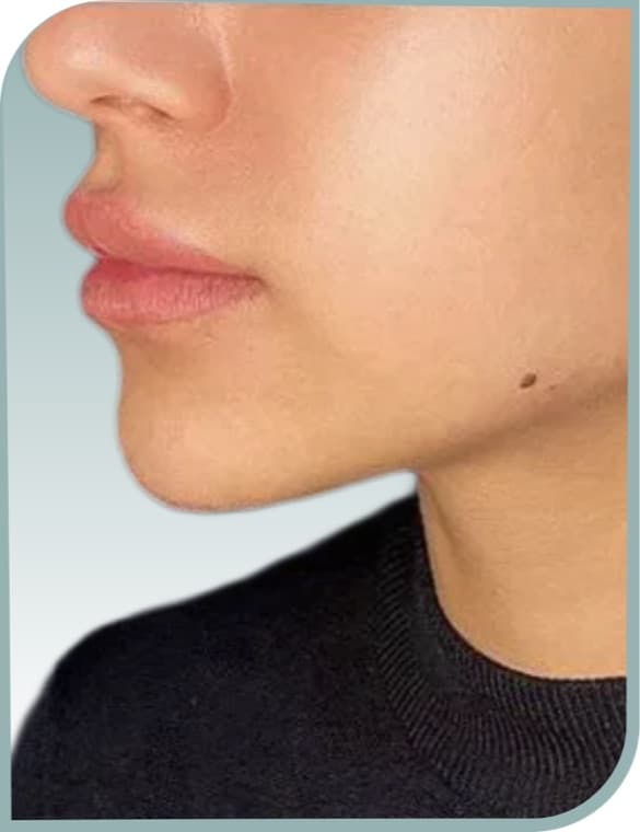 Jaw and neck contour, After photo (result 5 of 10)