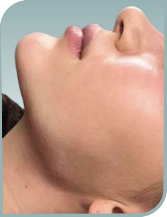 Submental contour, After photo (result 6 of 10)