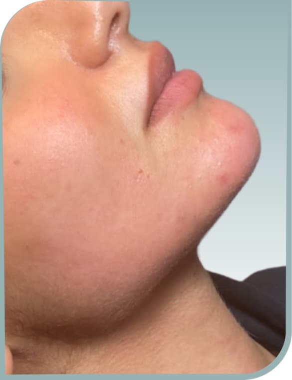 Jawline definition, After photo (result 3 of 6)