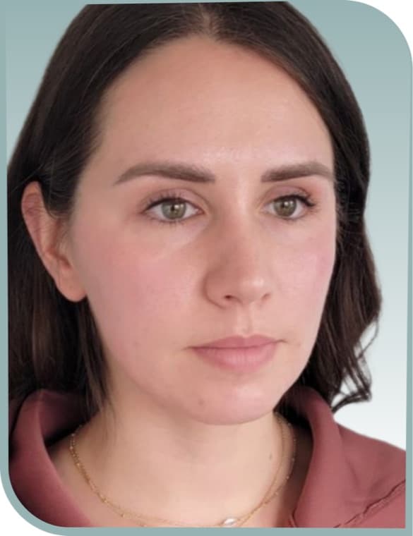 Jawline and jowl lift, Before photo (result 1 of 10)