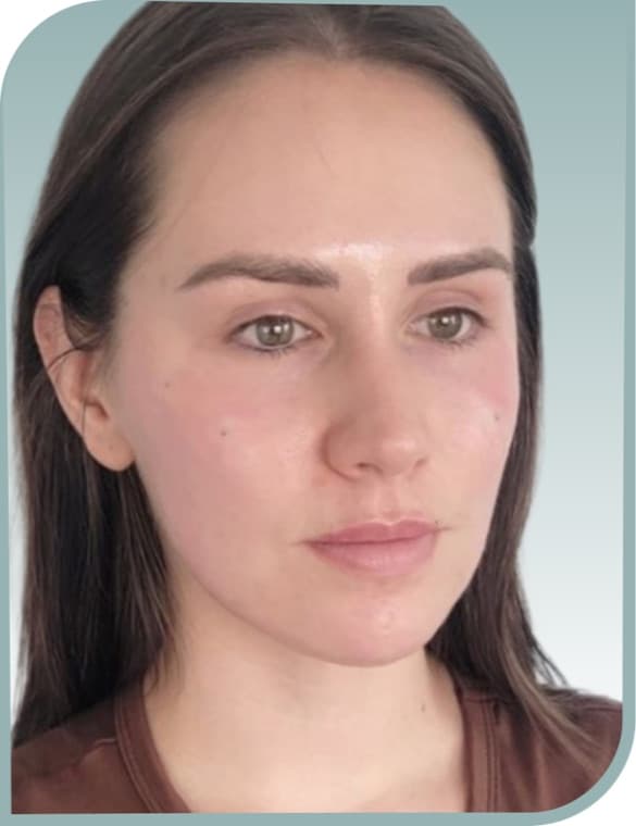 Jawline and jowl lift, After photo (result 1 of 10)