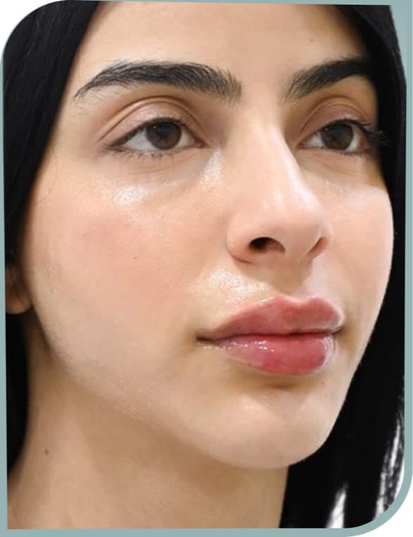Under-eye and mid face, After photo (result 10 of 10)