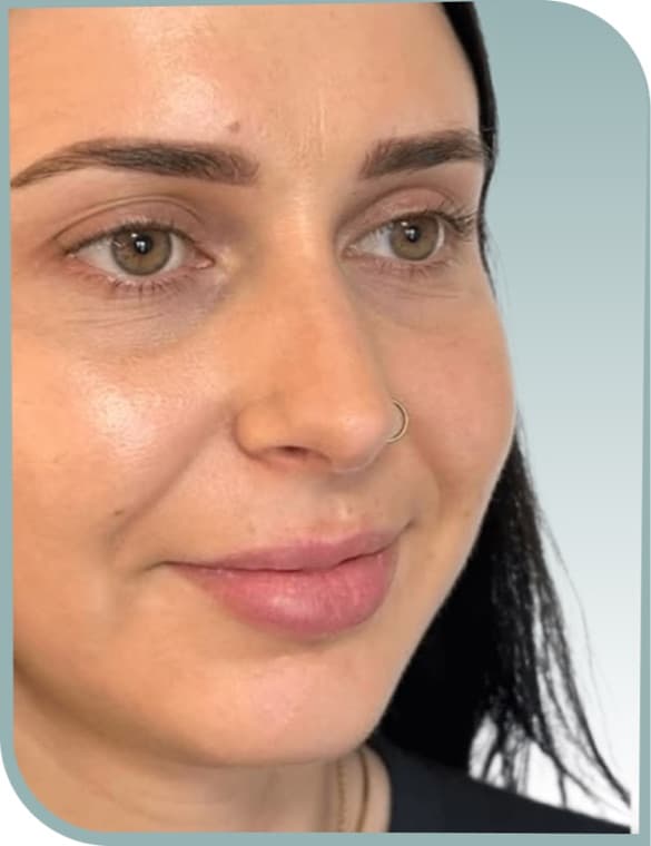 Cheek lift and calm, After photo (result 2 of 10)