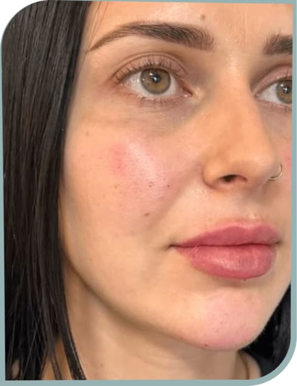 Cheek lift and calm, Before photo (result 2 of 10)