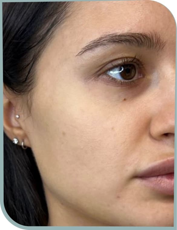 Under-eye and cheek, Before photo (result 3 of 10)