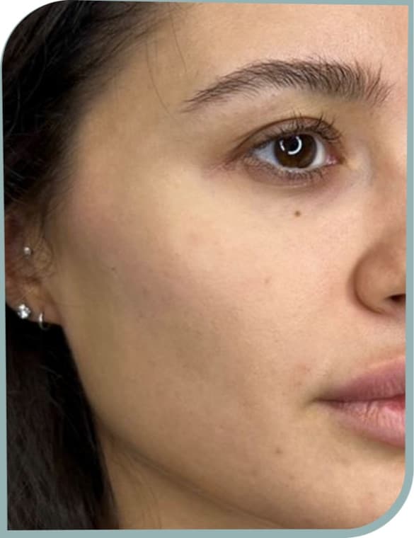 Under-eye and cheek, After photo (result 3 of 10)