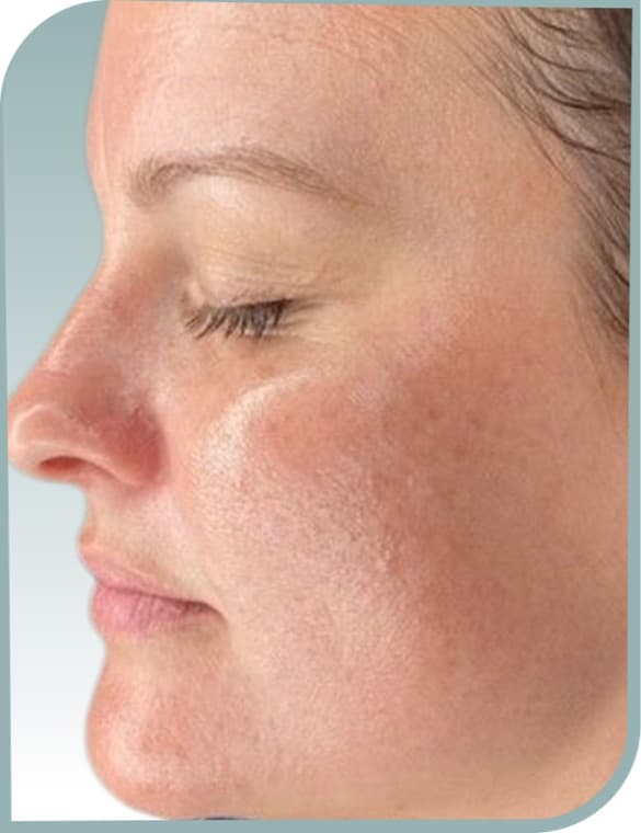 Cheek firmness lift, Before photo (result 4 of 10)