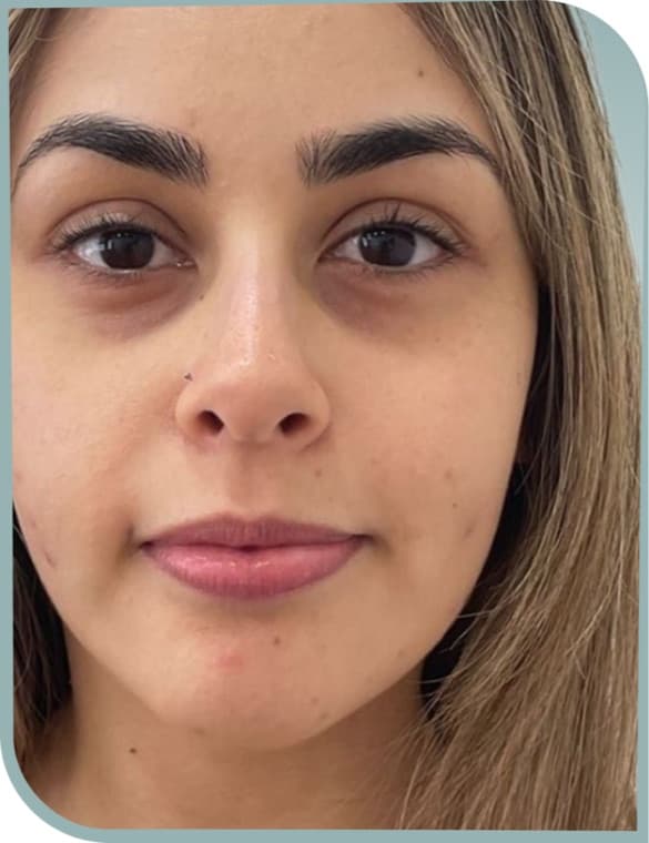 Under-eye brightening, Before photo (result 5 of 10)