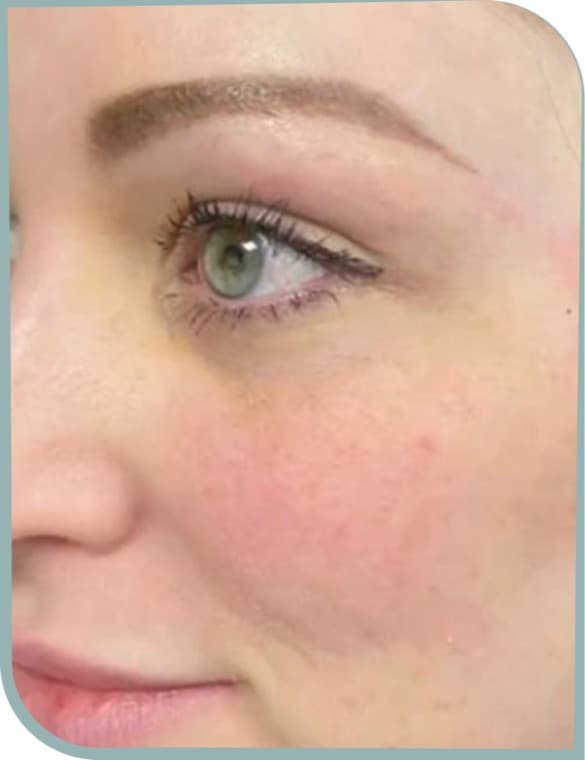 Under-eye and cheek, Before photo (result 6 of 10)