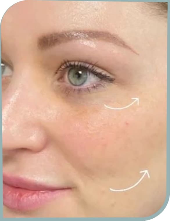 Under-eye and cheek, After photo (result 6 of 10)