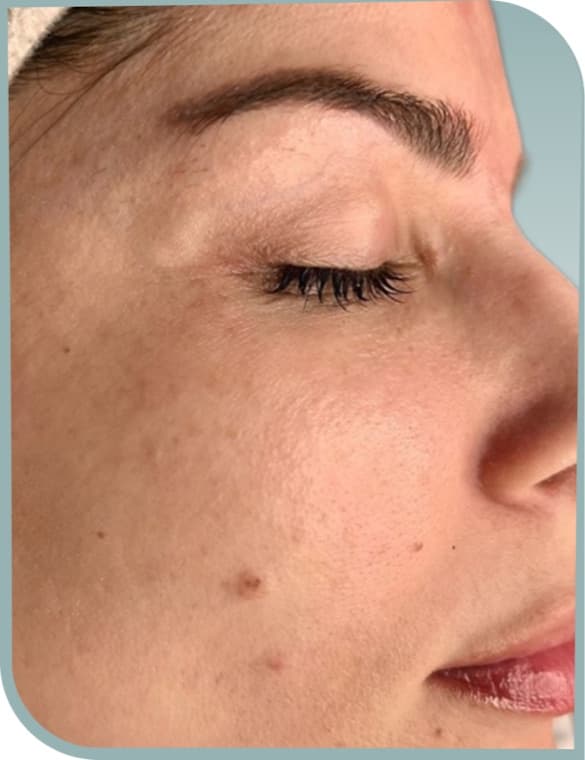 Under-eye smoothing lift, Before photo (result 7 of 10)