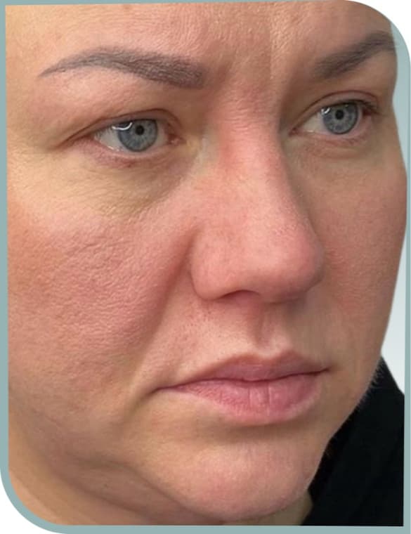 Cheek support lift, Before photo (result 9 of 10)