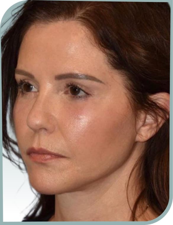 Midface and jaw, After photo (result 4 of 6)