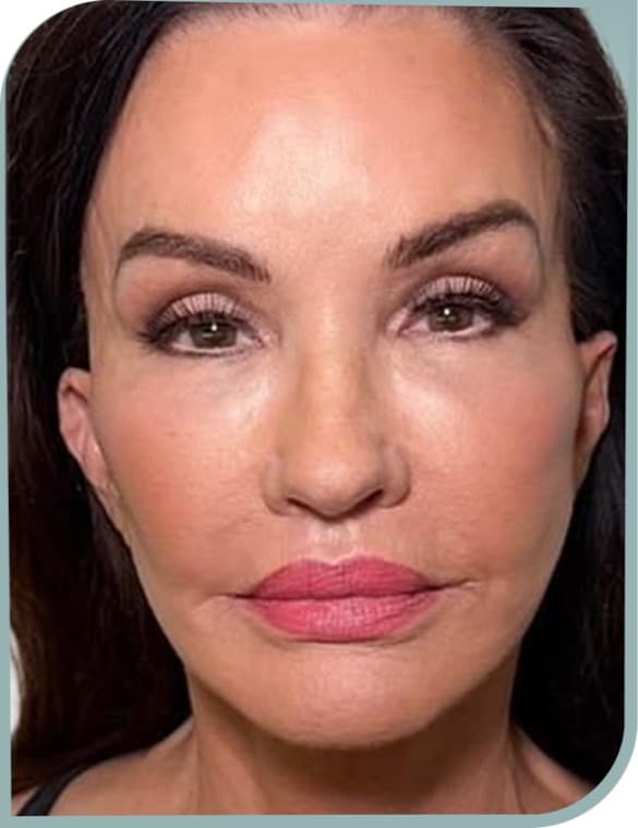 Overall facial laxity, After photo (result 6 of 6)