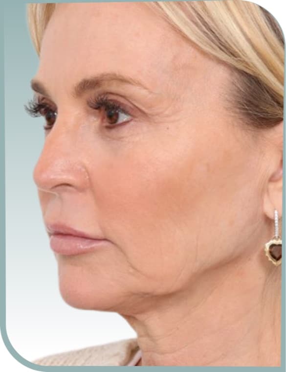 Jawline definition, Before photo