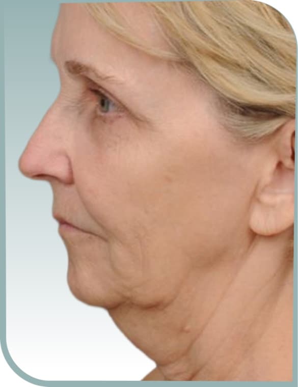 Jowl in profile, Before photo (result 2 of 6)