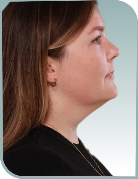 Jaw and neck contour, Before photo (result 3 of 6)