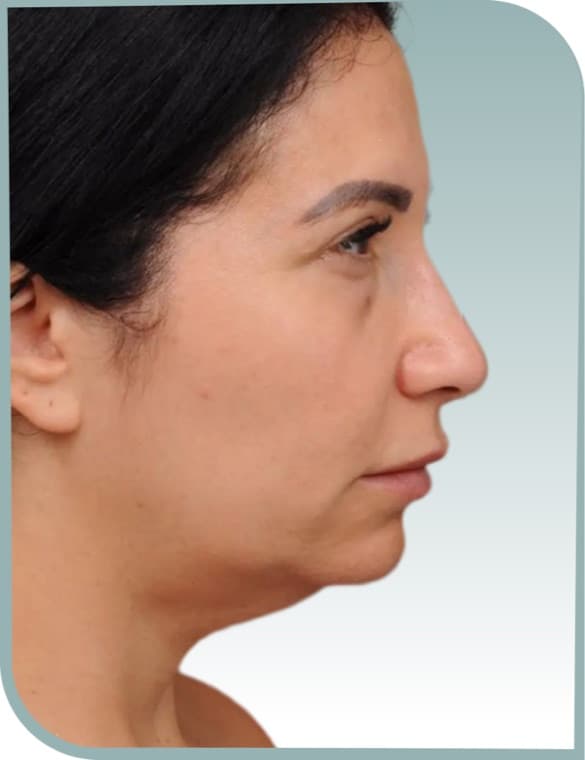 Midface and jaw, Before photo (result 4 of 6)