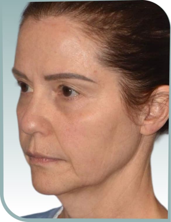 Submental fullness, Before photo (result 5 of 6)