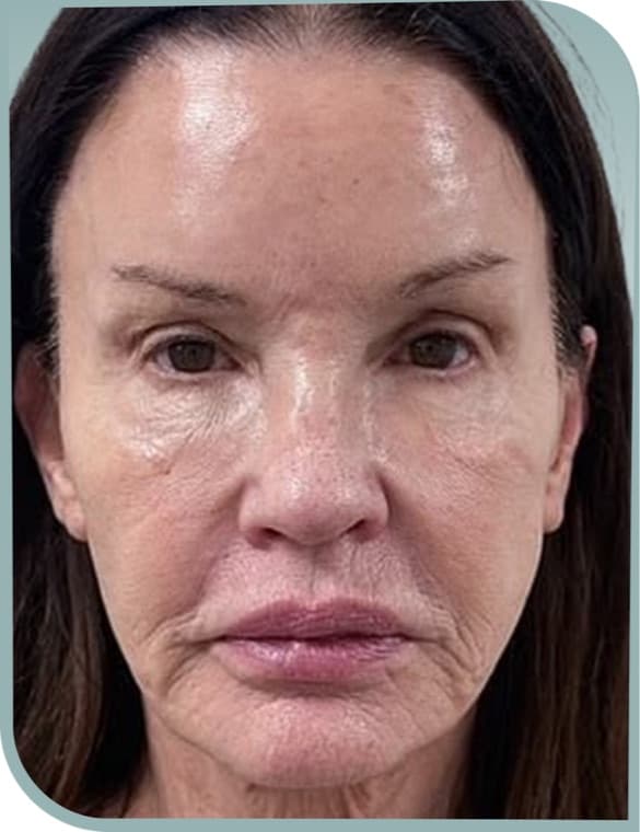 Overall facial laxity, Before photo (result 6 of 6)