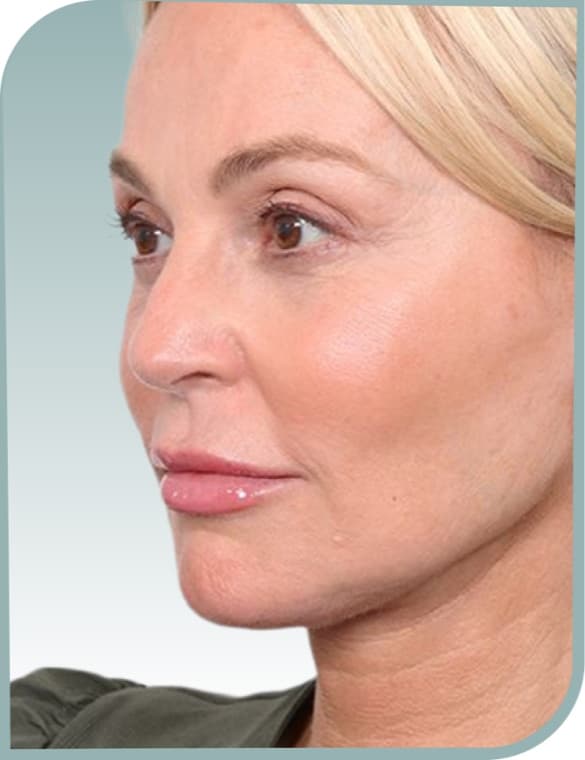 Jawline definition, After photo