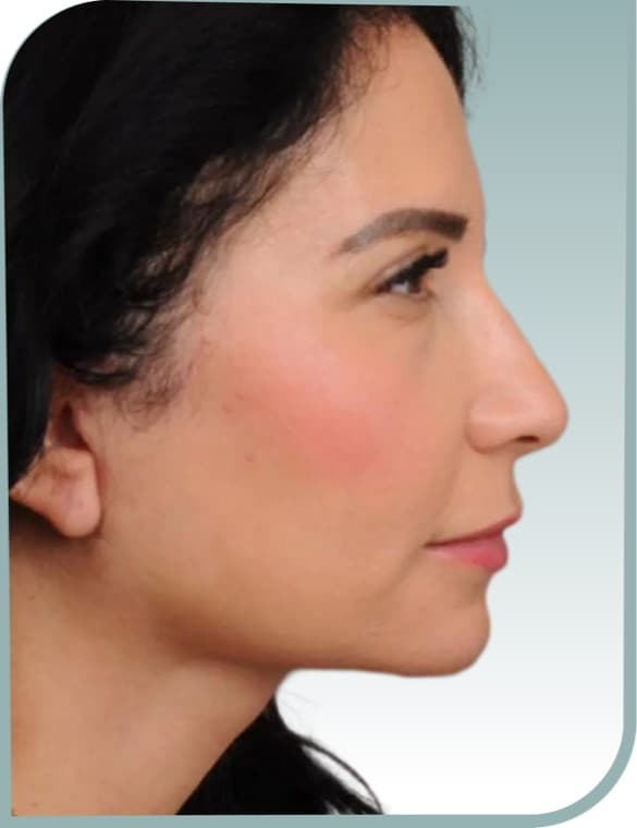 Jaw and neck contour, After photo (result 3 of 6)