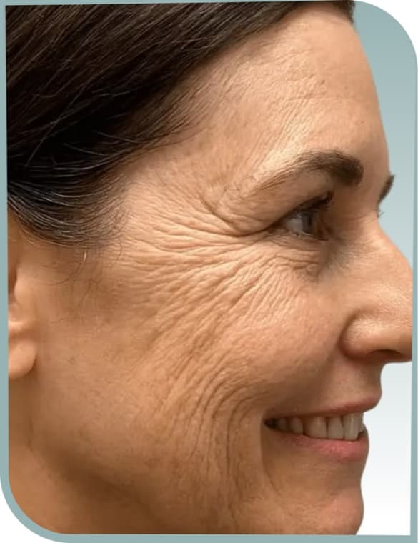 crow's feet softened, Before photo (result 1 of 10)