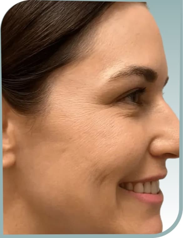 crow's feet softened, After photo (result 1 of 10)