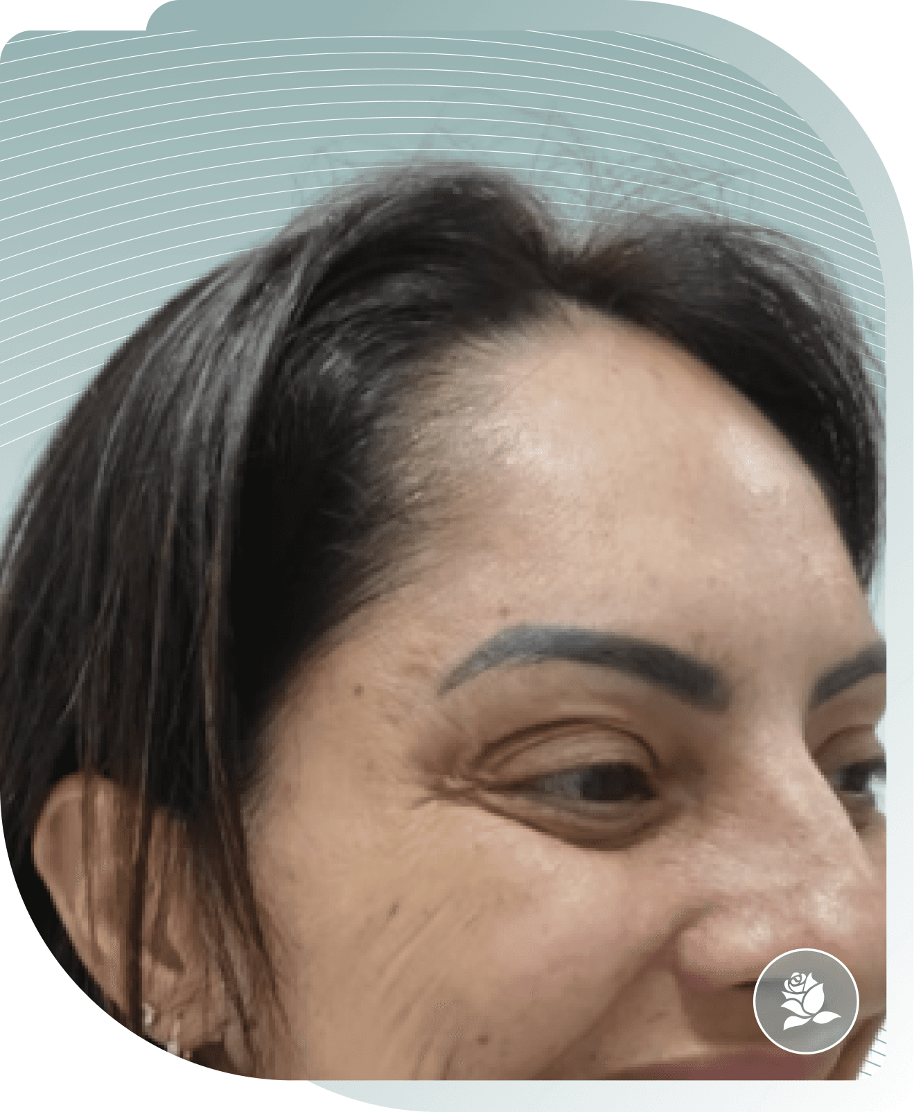 After photo: Wrinkle Relaxing result at Carisma Aesthetics Malta