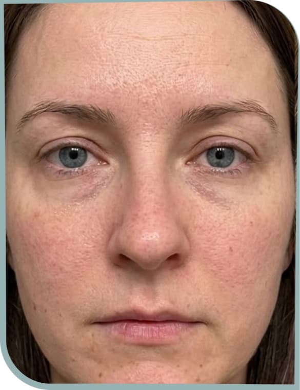 forehead lines relaxed, Before photo (result 10 of 10)