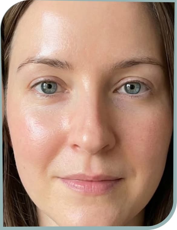 forehead lines relaxed, After photo (result 10 of 10)