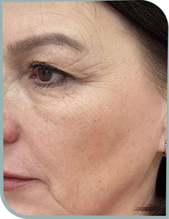 eye area lines, Before photo (result 2 of 10)