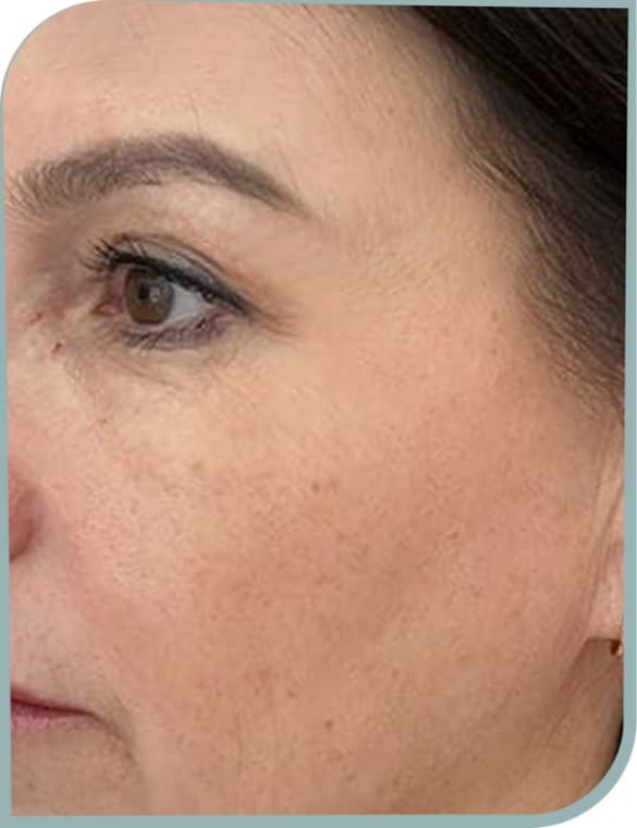eye area lines, After photo (result 2 of 10)