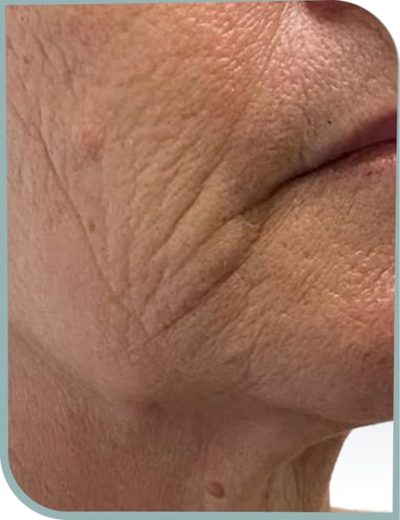 lower face creasing, Before photo (result 3 of 10)
