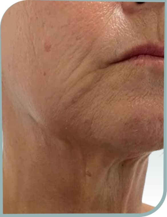 lower face creasing, After photo (result 3 of 10)