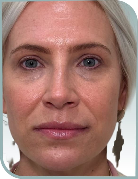 forehead lines smoothed, After photo (result 4 of 10)
