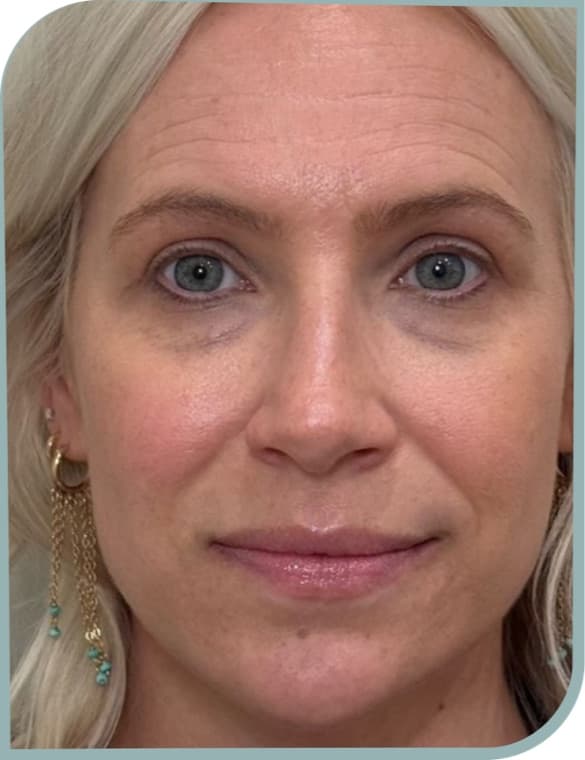 forehead lines smoothed, Before photo (result 4 of 10)