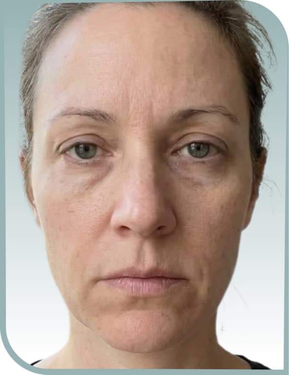 frown line relaxed, Before photo (result 5 of 10)