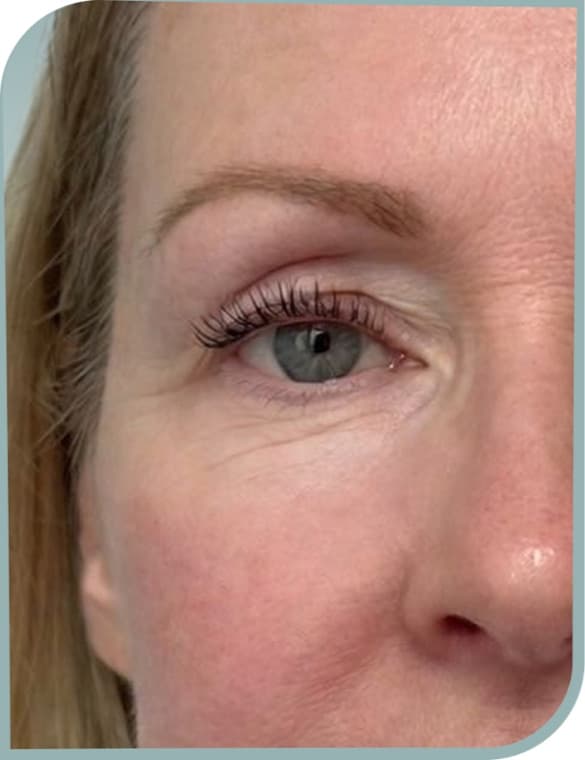 crow's feet eased, After photo (result 6 of 10)