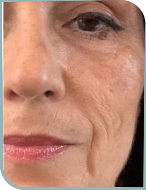 crow's feet reduced, Before photo (result 7 of 10)