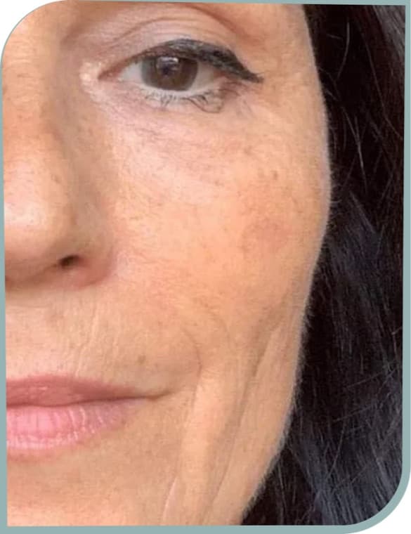 crow's feet reduced, After photo (result 7 of 10)