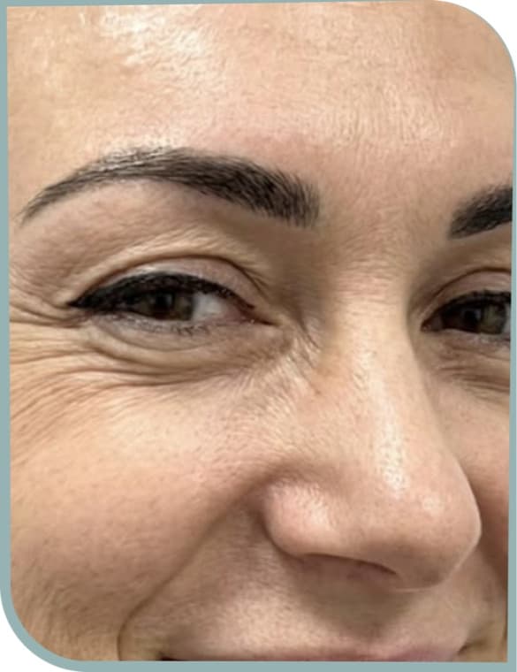 crow's feet eased, Before photo (result 8 of 10)